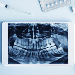 X ray of teeth on tablet screen
