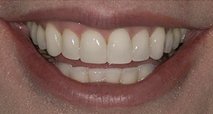 Anna smiling after cosmetic dental bonding