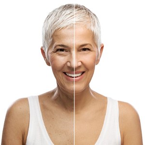 A before and after image of an older woman who has received Botox
