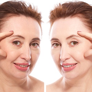 The before and after photos of a middle aged woman who has received Juvederm