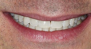 Close up of smile after treatment with clear aligners