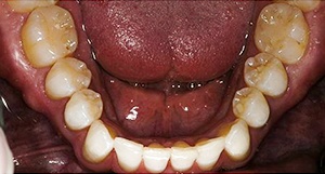 Row of bottom teeth after clear aligners
