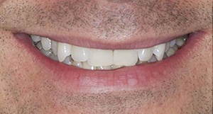 Close up of smile before clear aligner treatment