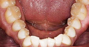 Row of bottom teeth before clear aligners