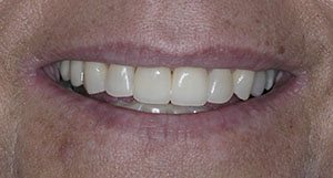 Close up of smile after getting composite veneers