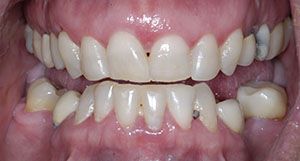 Close up of smile before getting composite veneers