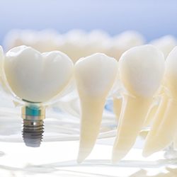 model of a single dental implant surrounded by natural teeth