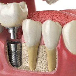 Illustrated dental crown being fitted onto a dental implant in Albuquerque