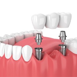 Illustrated dental implant bridge replacing three missing teeth