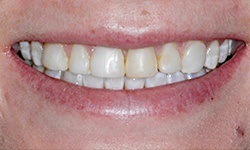 Close up of smile with stained teeth before treatment from dentist in Albuquerque