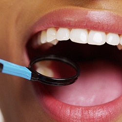 Dental mirror checking mouth with dental inlays and onlays in Albuquerque