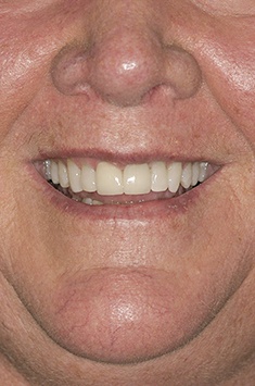 Albuquerque dental patient Jill smiling