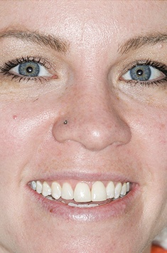 Albuquerque dental patient Kasey smiling