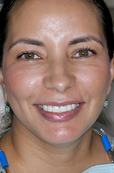 Albuquerque dental patient Kim smiling