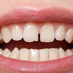 An up close image of a person smiling and the gap between their upper front two teeth