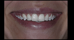 Smile after composite veneers treatment