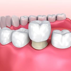 Illustration of dental crown being placed over a tooth