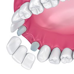 Illustration of dental bridge replacing a missing upper tooth