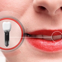 Illustration of dental implant next to mouth of person with all of their teeth