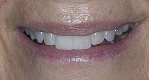 Close up of smile after composite veneers