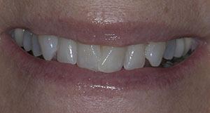 Close up of smile before treatment with composite veneers