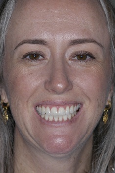 Albuquerque dental patient Odessa smiling