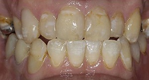 Smile after cosmetic dental bonding