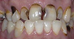 Mouth before cosmetic dental bonding