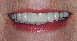 Polly smiling after getting porcelain veneers and crowns
