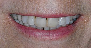 Polly smiling before porcelain veneers and crowns