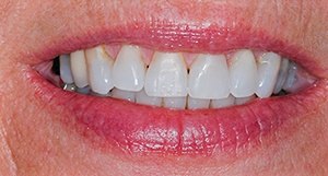 Robin smiling after clear aligners