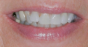 Robin smiling before clear aligners