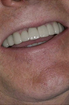Albuquerque dental patient Russ smiling
