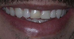 Close up of smile after Invisalign