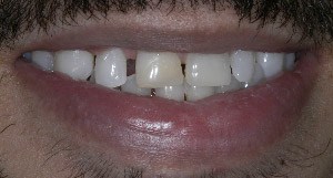 Close up of smile before Invisalign