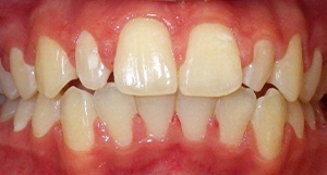 Tani smiling after getting composite veneers
