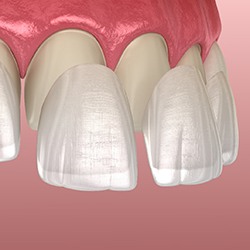 Two illustrated veneers being placed over teeth