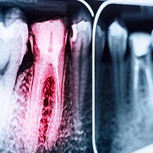 X ray of damaged tooth needing root canal treatment in Albuquerque