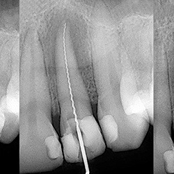 X ray of a tooth that has received a root canal in Albuquerque