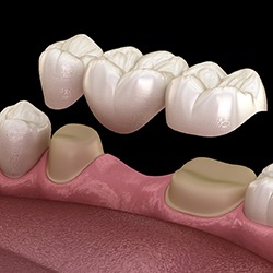 Illustrated dental bridge replacing one missing tooth