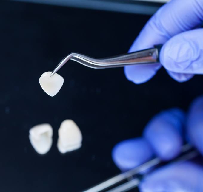 Gloved hands picking up veneers with forceps