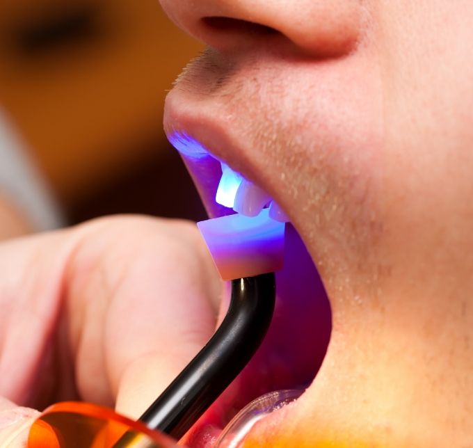 Cosmetic bonding being performed on upper teeth