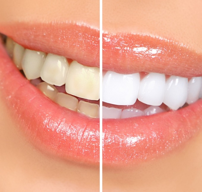 Smile before and after teeth whitening