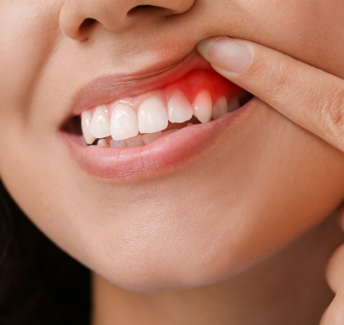 Woman pulling up lip to show gums
