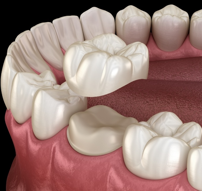 A young man pointing to his smile with dental crowns in Albuquerque