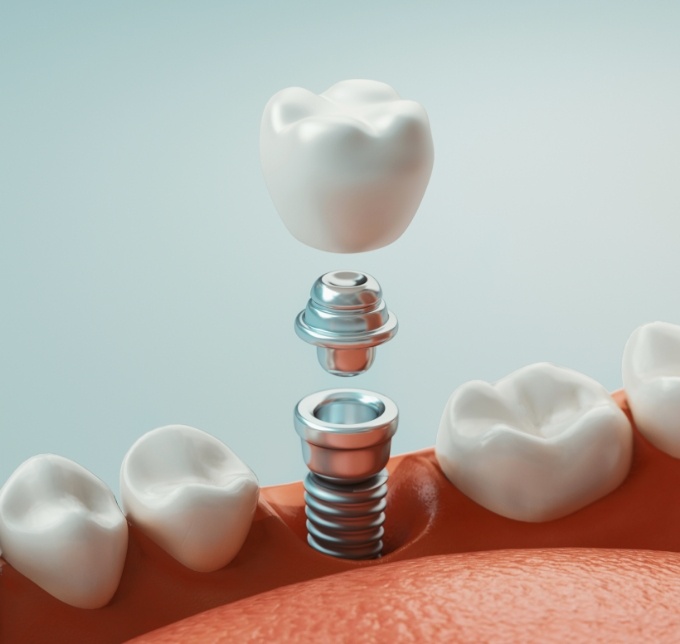 Illustration of dental implant in Albuquerque along with abutment and crown