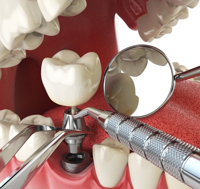 Using dental instruments to place dental implants