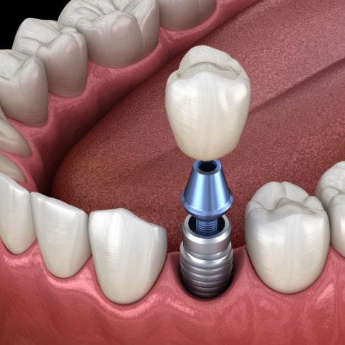 Illustration of single dental implant and crown in jaw