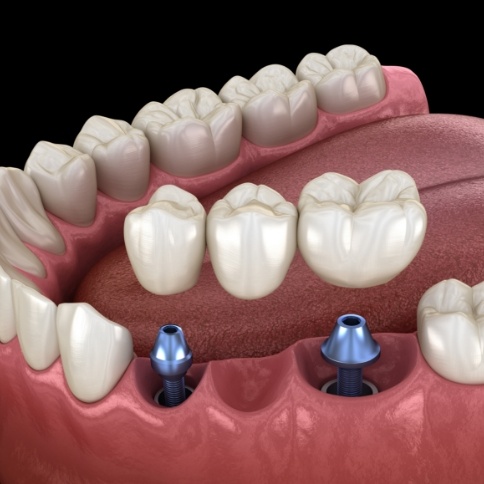 Illustration of dental bridge being attached to two dental implants
