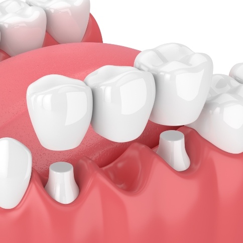 Illustration of a dental bridge being placed